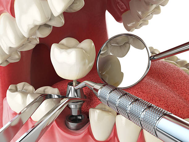 Best Broken or Cracked Tooth Emergency Dentist in Tucker, GA